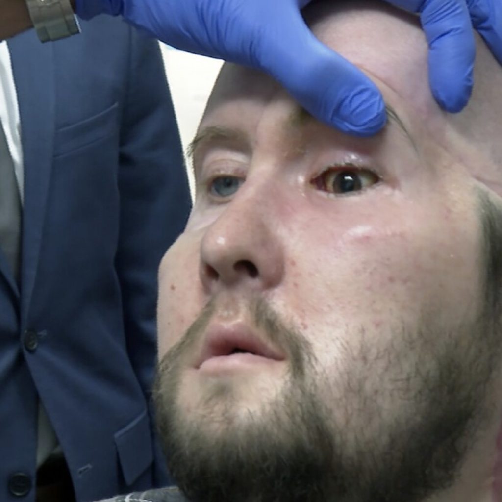 Man receives the first eye transplant plus a new face. It’s a step toward one day restoring sight | AP News