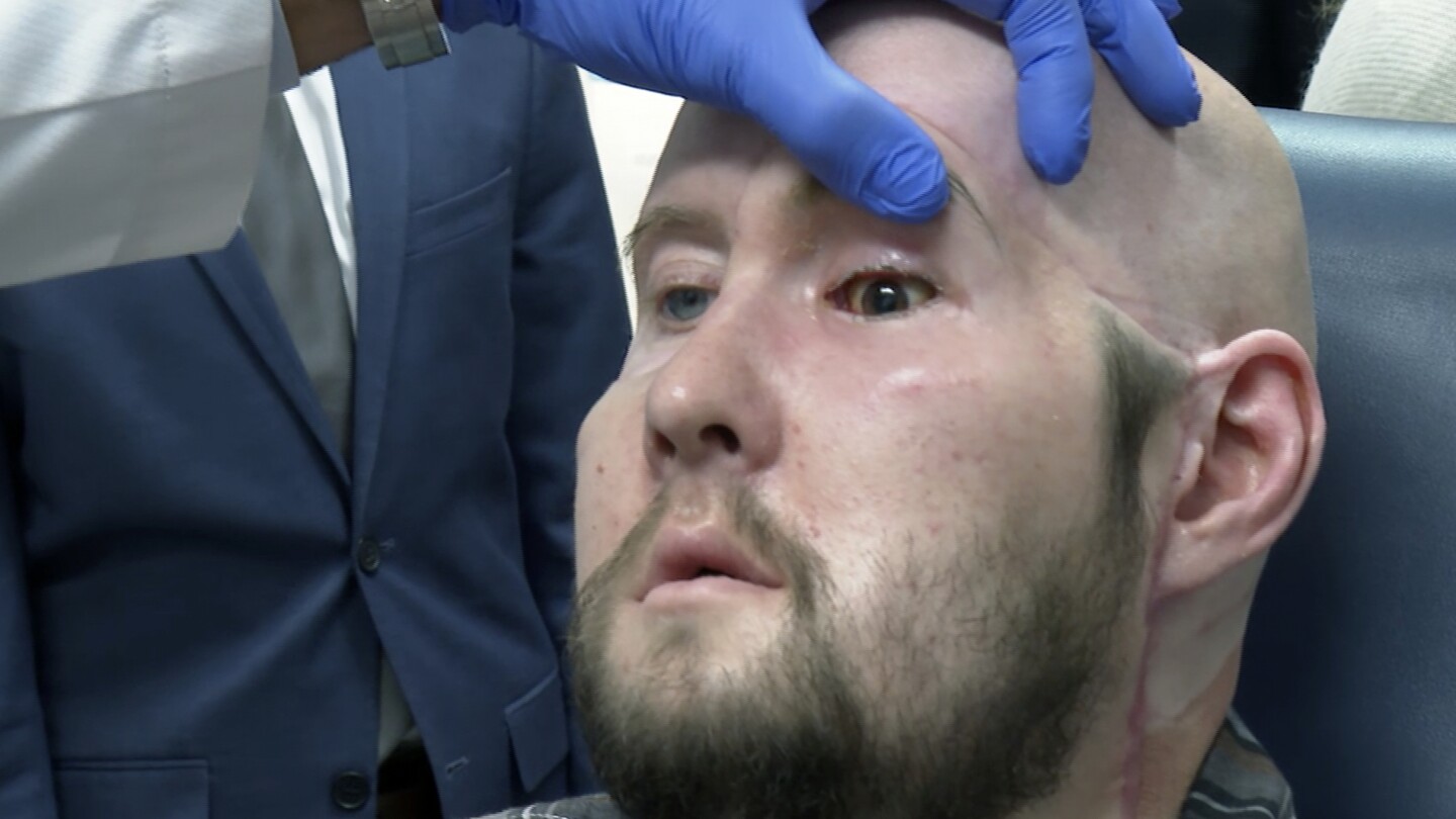 Man receives the first eye transplant plus a new face. It’s a step toward one day restoring sight | AP News