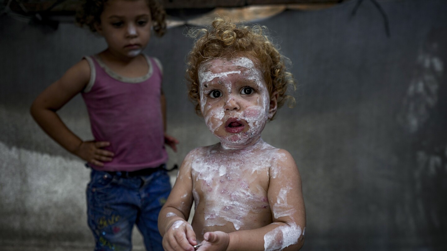 Lice, scabies, rashes plague Palestinian children as skin disease runs rampant in Gaza’s tent camps