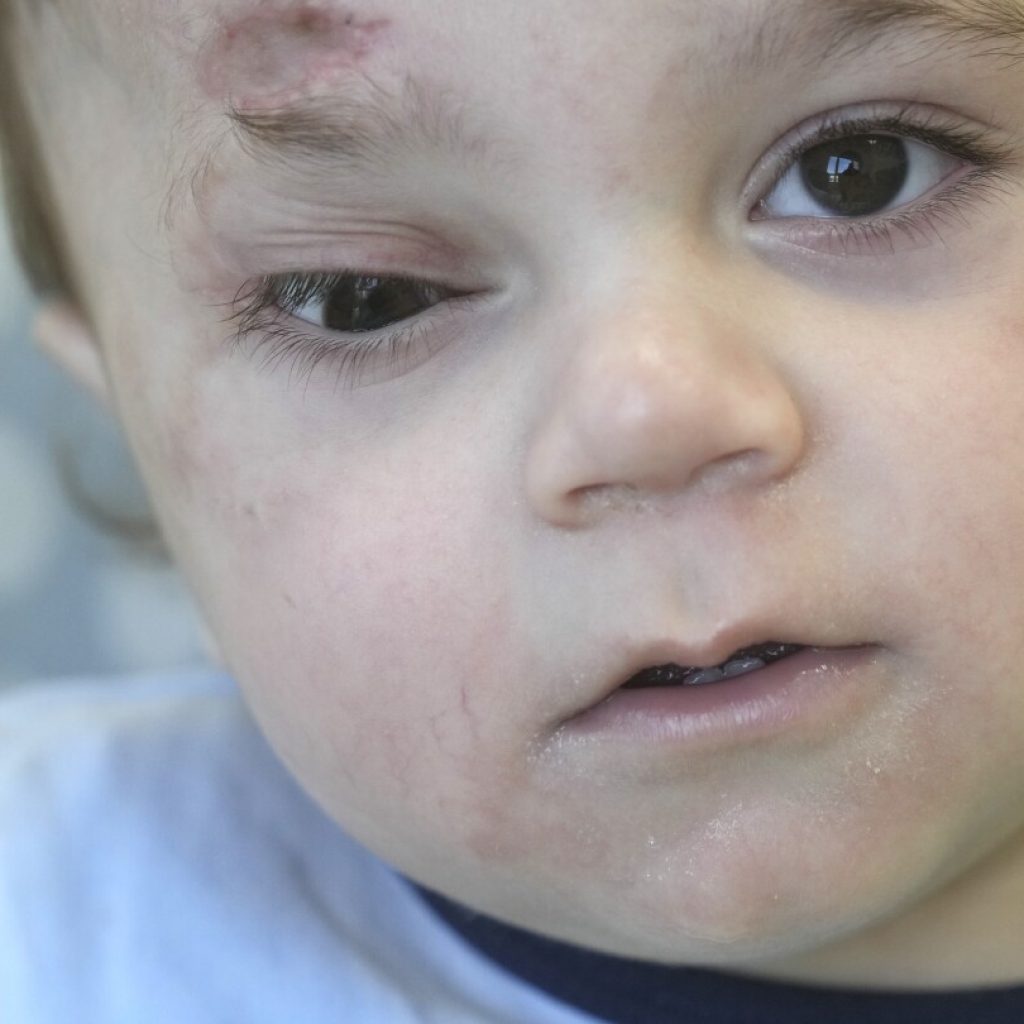 A baby evacuated from Gaza lost an eye and most of his family in the war