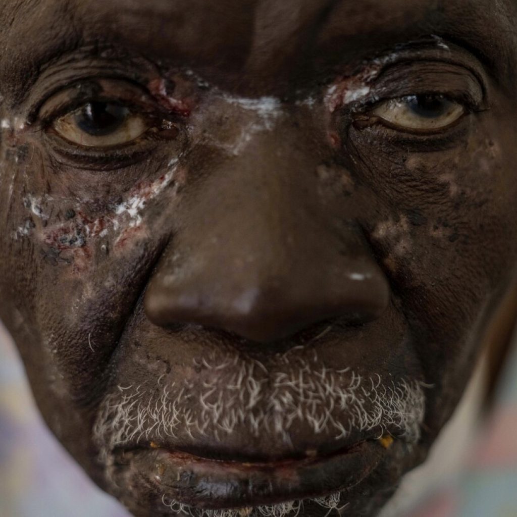 A photographer captures the mpox health crisis in Africa in a closeup