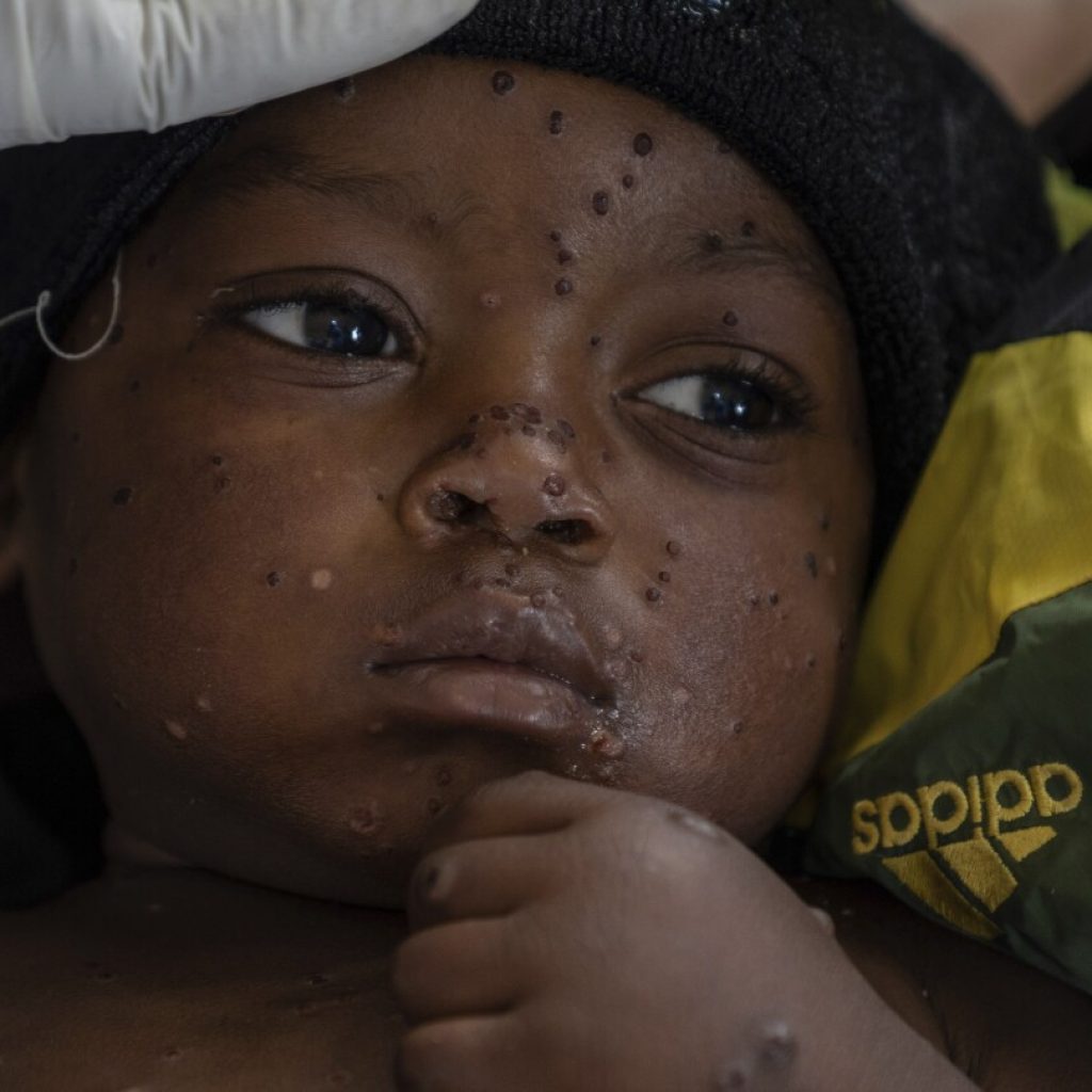 A gold mining town in Congo has become an mpox hot spot as a new strain spreads